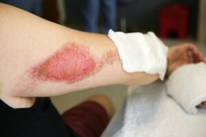 Boston Motorcycle Accident Injuries road rash